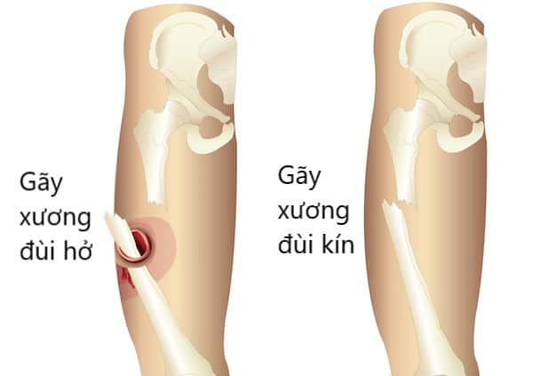 Ảnh 3 của Foot fracture